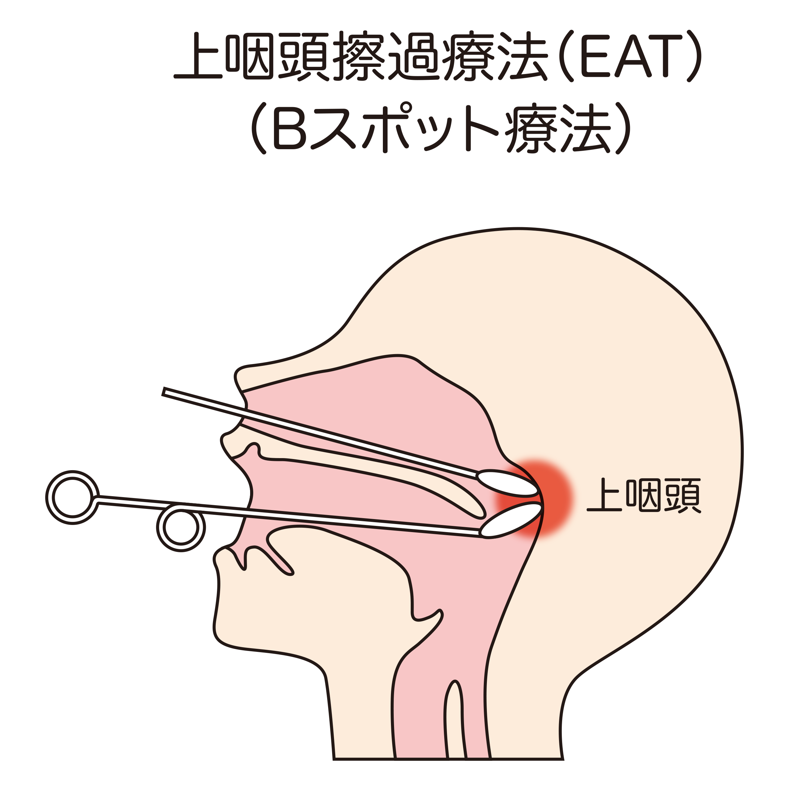 Bスポット治療
